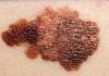 Melanoma on the skin